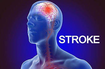 stroke-symptoms-and-treatment_edited.jpg