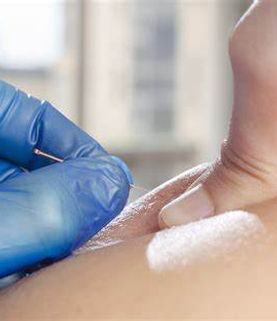 dry needling.jfif