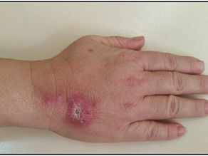 Pelotas registra aumento de esporotricose em humanos e felinos