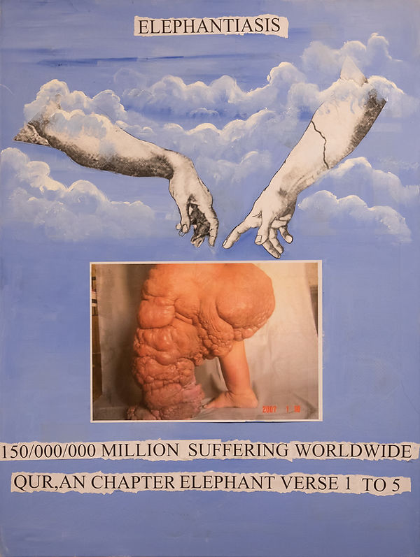 Elephantiasis.jpg