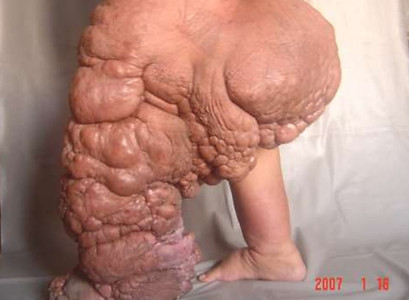 elephantiasis-5-638.jpg