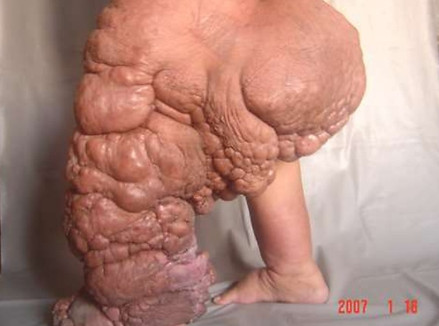 elephantiasis-5-638.jpg