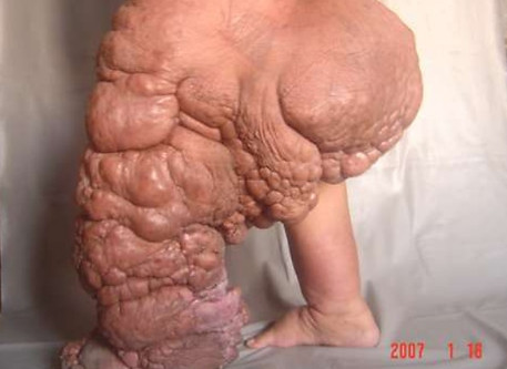 elephantiasis-5-638.jpg