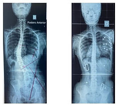 RX  coluna vertebral com escoliose