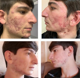acne impacted skin