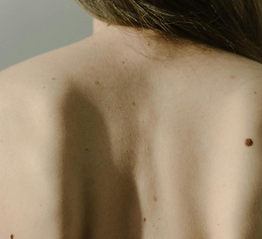 Leberfleck1.jpg