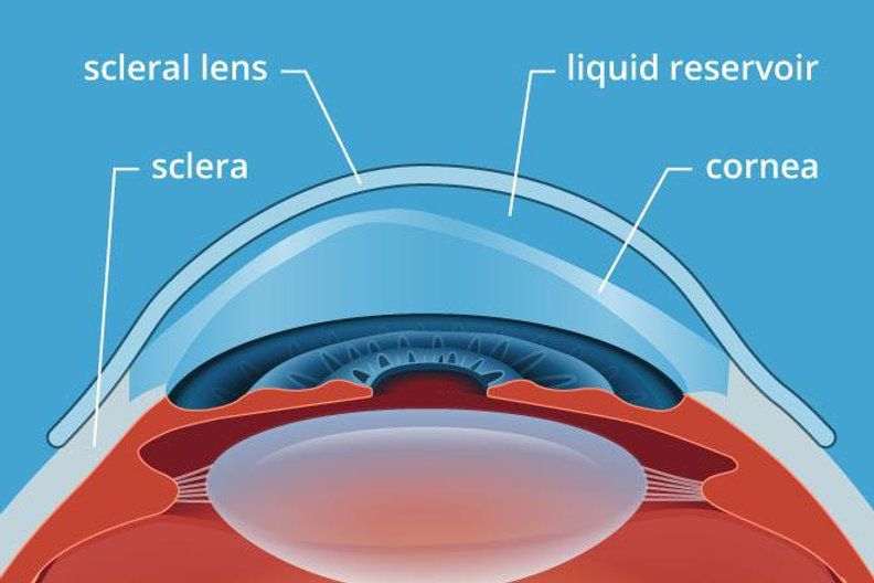 What are Scleral Lenses and Who Can Benefit from Them?