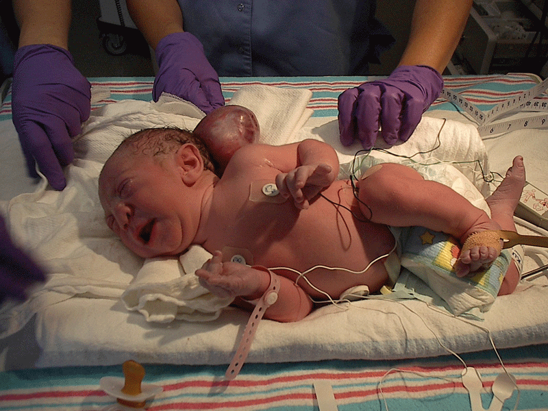 Nathan Valentine-occipital encephalocele miracle