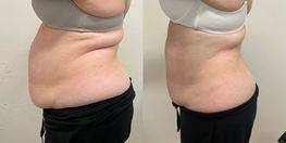 Side-by-side before and after photos demonstrating effective fat cavitation and RF skin tightening results Melbourne