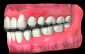 Night Guards ad Occlusal Appliances at Cape Cod Restorative Dentistry