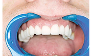 Metal Free Crowns & Bridges at Cape Cod Restorative Dentistry
