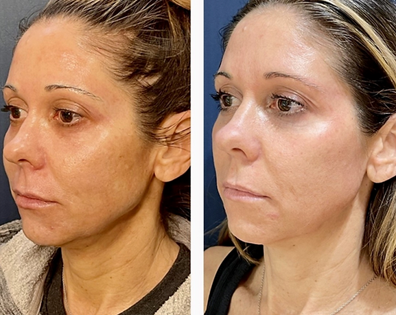 brown spot and pigmentation concerns treated with sciton moxi and bbl hero.png