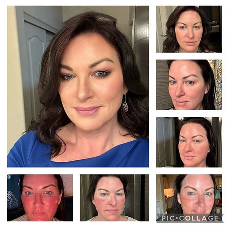 laser facelift at ageless med spa scottsdale (1).jpg