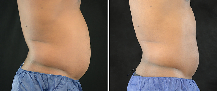 weight loss and body contouring scottsdale.png