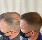 Hair Loss Solution