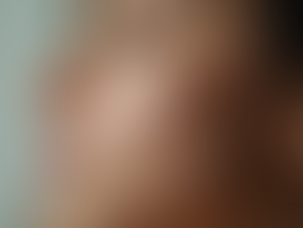 Understanding What Causes Stretch Marks