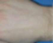Laser Hair Removal-hand-after