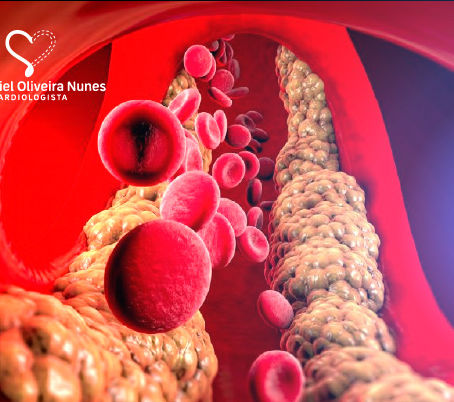Lipoproteína(a) [Lp(a)]: o Fator de Risco Genético para Infarto que Muitas Pessoas Não Conhecem