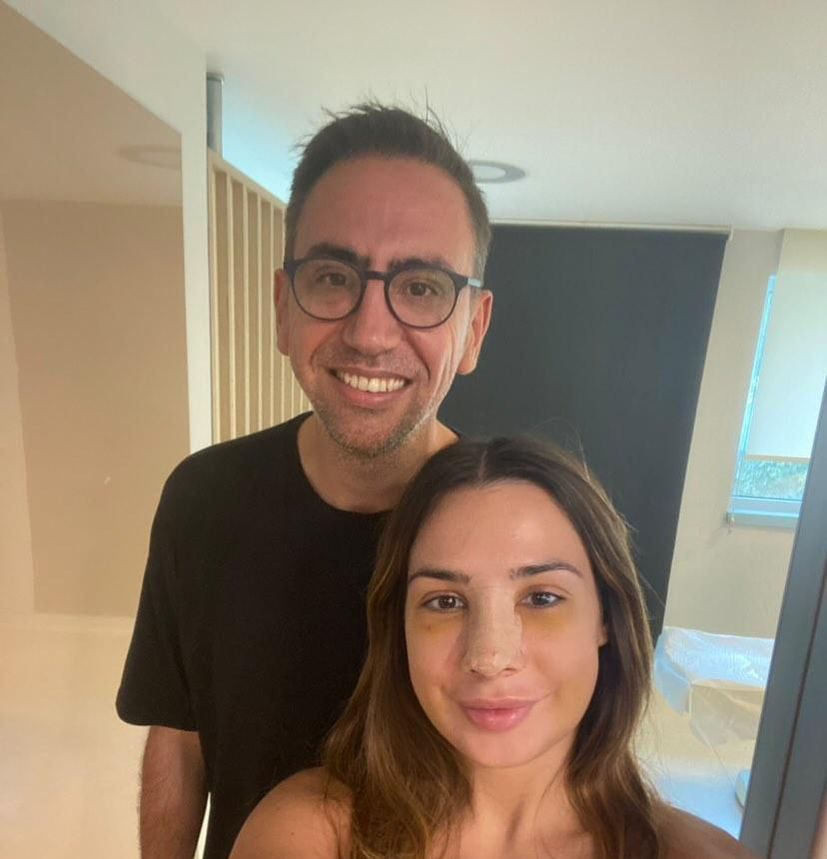 Nice nose job done in Turkey