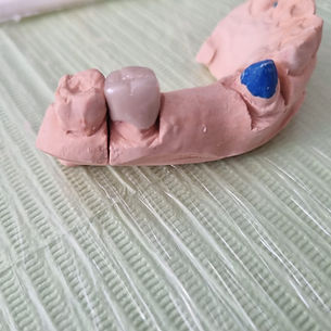 Corona Metal Porcelana