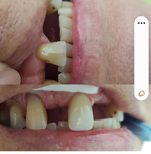 Carilla Estética del Diente Central Superior