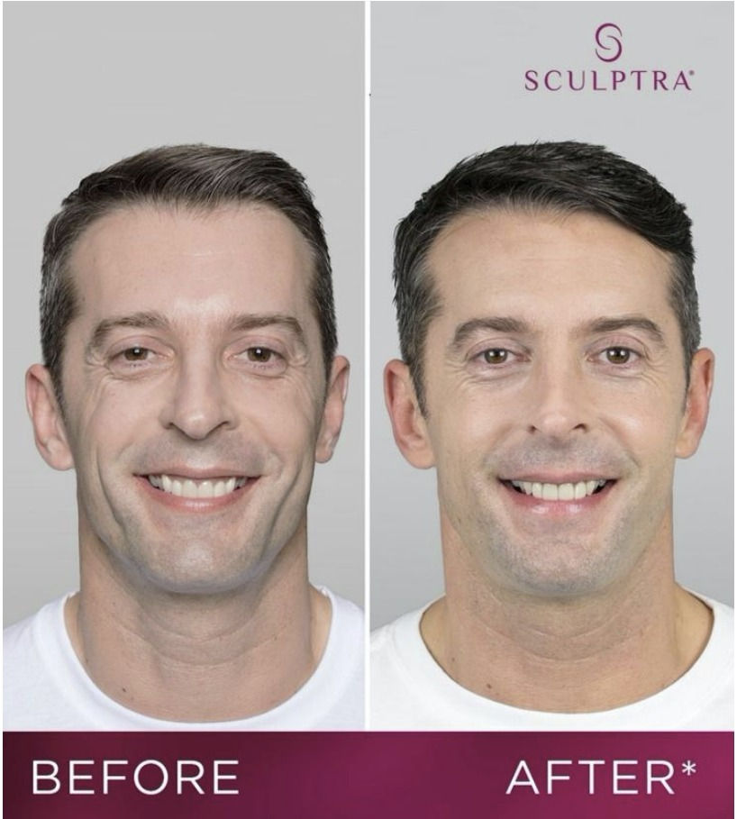 Before and After results of Sculptra