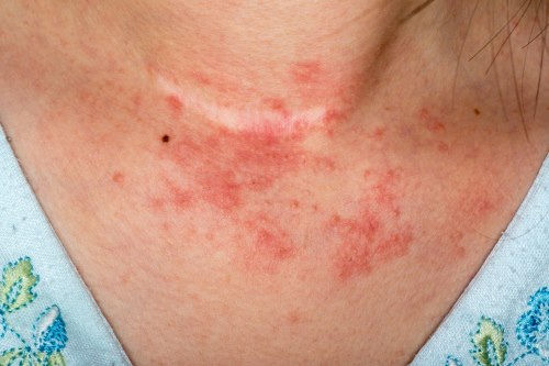 DERMATITIS 003