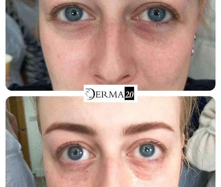 Derma 2.0 Lifting
