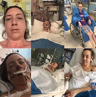 Sarah, a survivor of meningococcal w and sepsis, details the impact of the disease.