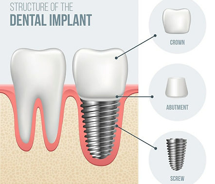 2-3 implant know.jpg