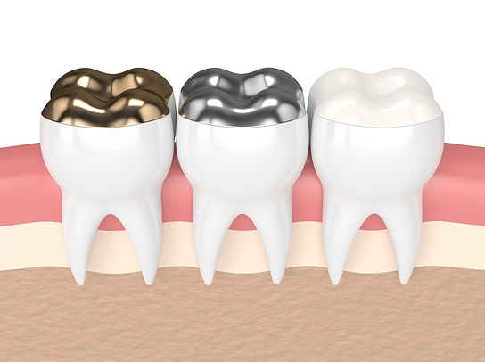 8-3 Dental Filling.jpg