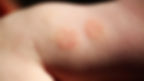 Eczema