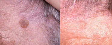 Laser Resurfacing