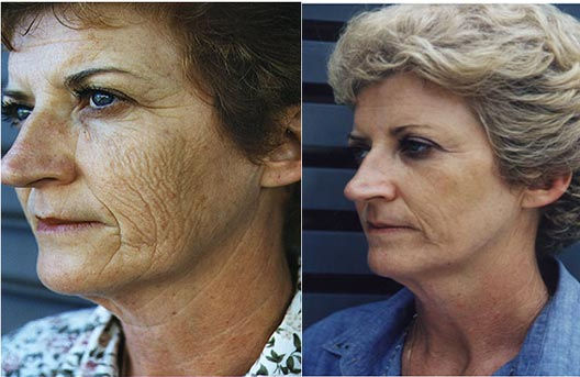 Laser Resurfacing