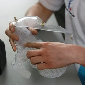 Innovative 3D Printing Revolutionizes Treatment of Facial Burns in Children