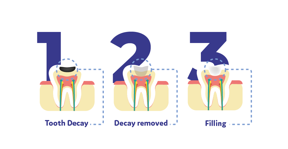 Three-step diagram showing dental treatment progression: tooth decay, decay removed, and filling placed to restore the tooth.