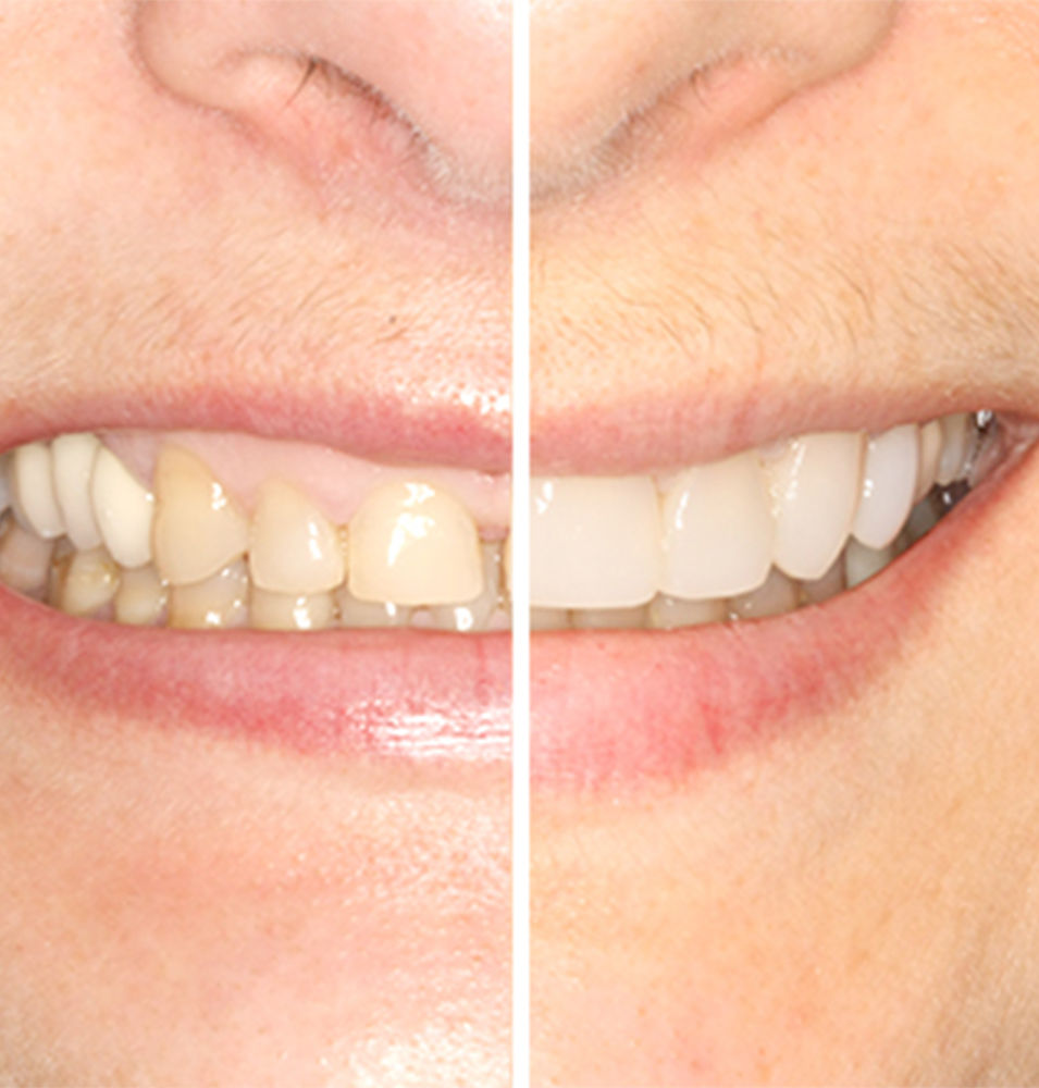 gap-between-teeth-diastema-2