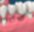 Dental-bridge-inplant-west-auckland-dentist