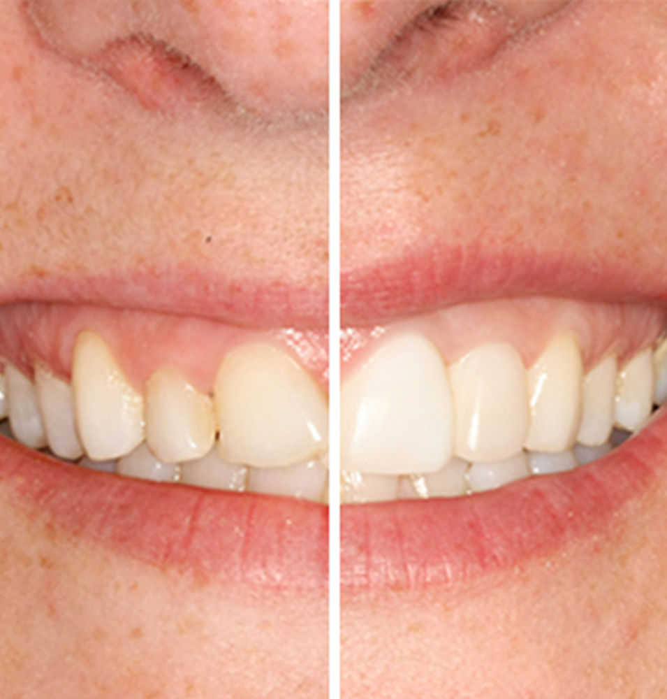 veneers-west-auckland-dentist-2
