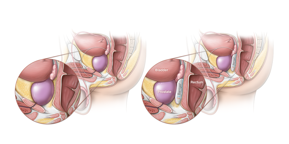 Two side-by-side illustrations showing a light-skinned person with sagittal XY reproductive anatomy revealed. On the left side is just the anatomy with a callout showing a closeup of the prostate and rectum; on the right side is the same illustration with a Barrigel HA spacer placed in the space between the prostate and rectum.