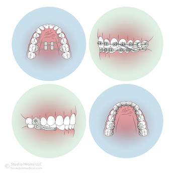 Four illustrated icons depicting different types of fixed oral appliances. The backgrounds of the icons are light blue and mint green.