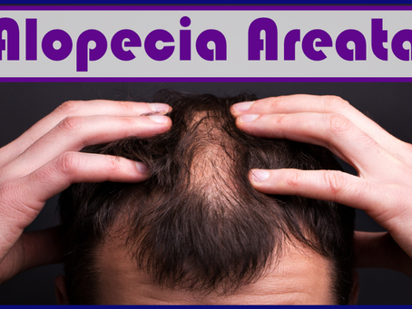 Alopecia areata