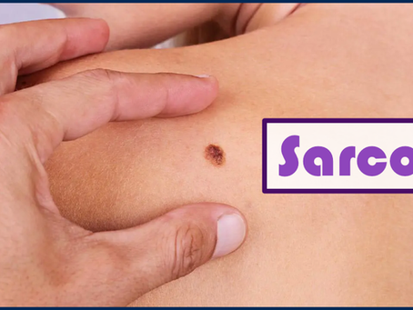 Sarcoma