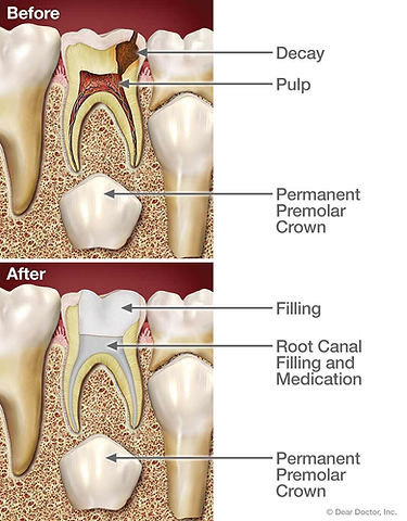 root-canal-treatment-for-children.jpg