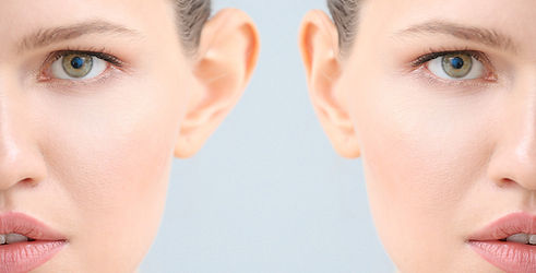otoplastia.jpeg