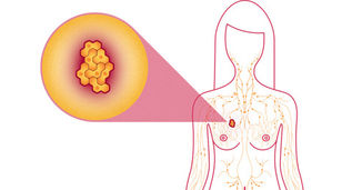 Using Natural Progesterone to Prevent Breast Cancer
