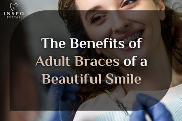 The Benefits of Adult Braces for a Beautiful Smile