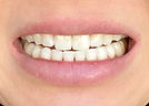 teeth close up front view