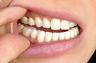 teeth right view