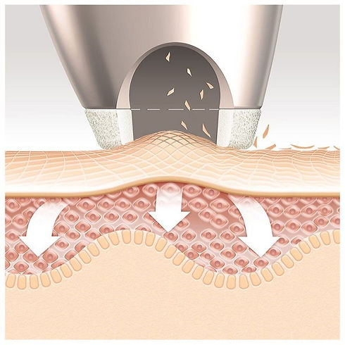 Microdermabrasion-grafik-800x800.jpeg